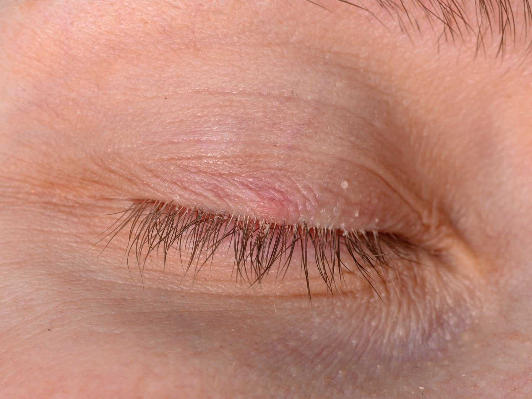 Demodex: der versteckte Auslöser juckender und trockener Augen 